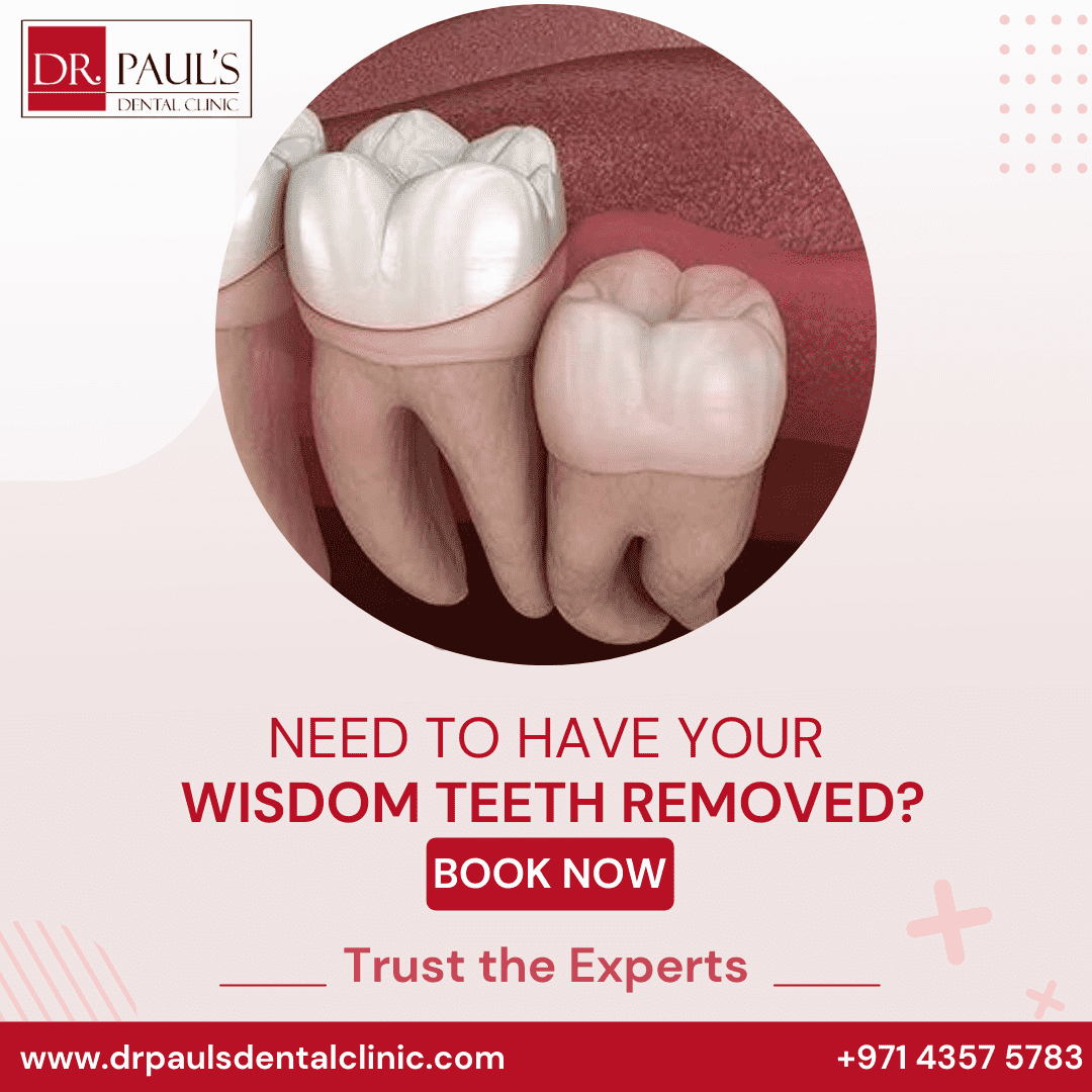 Wisdom tooth Extraction in Dubai